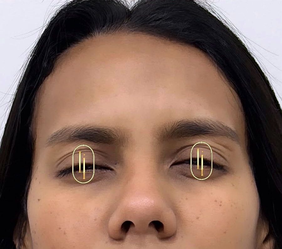 Depois do botox na glabela na Idôle
