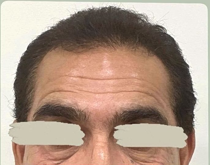 Antes do botox na testa na Idôle