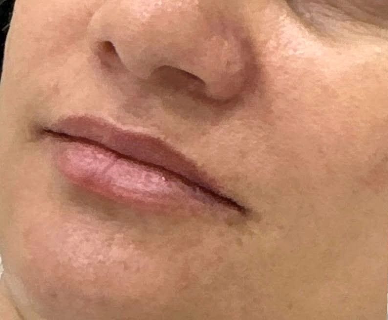 Antes do preenchimento labial na Idôle