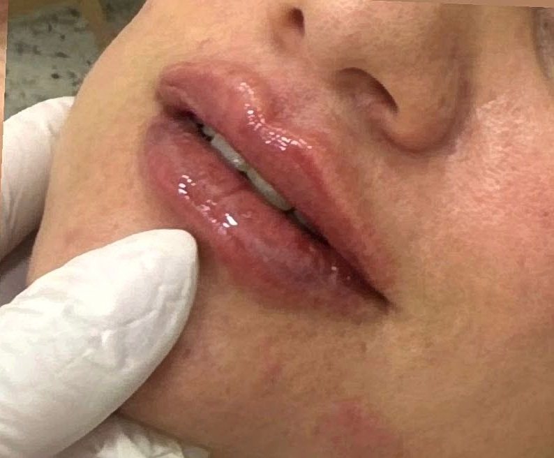 Depois do preenchimento labial na Idôle
