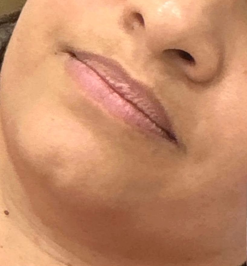 Antes do preenchimento labial na Idôle