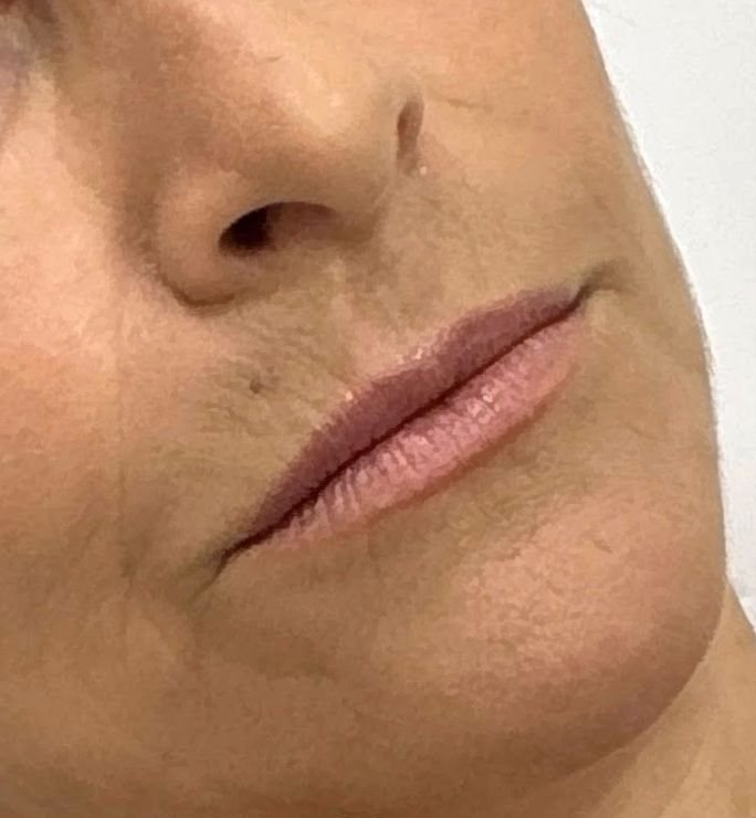 Antes do preenchimento labial na Idôle