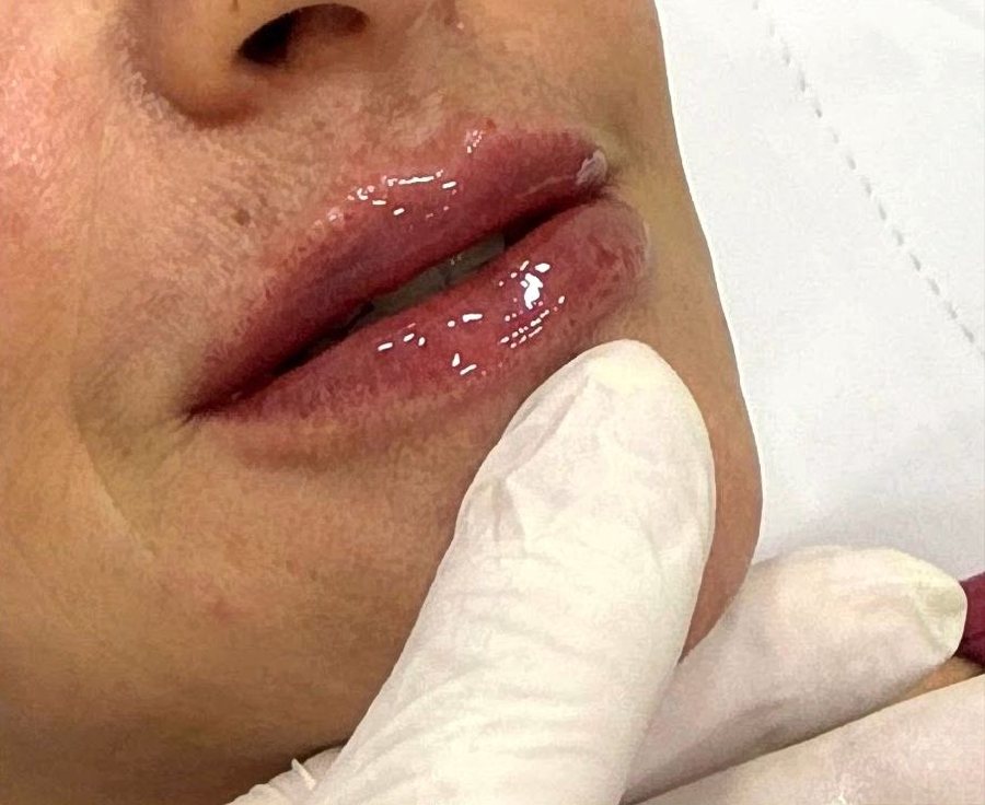 Depois do preenchimento labial na Idôle