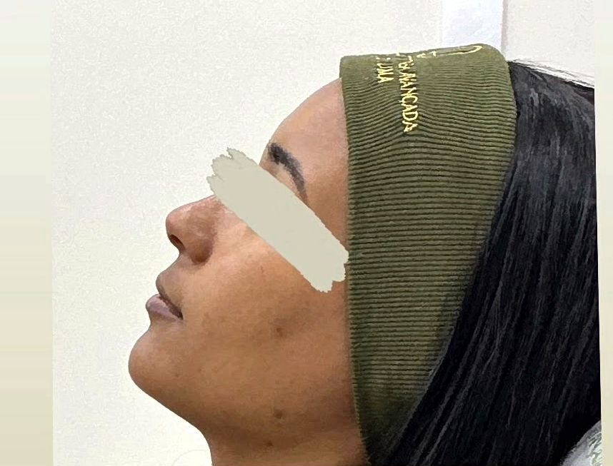 Antes do preenchimento labial na Idôle
